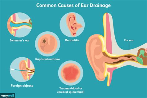 Causes and Treatment for Ear Drainage