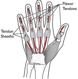 Flexor Tendon Injuries - Mendelson Kornblum