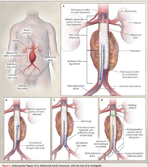 Figure 1 from Endovascular repair of abdominal aortic aneurysm ...