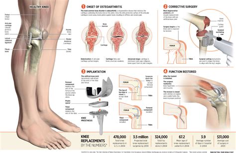 Knee Surgery // Explica Media