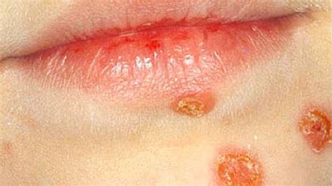 Impetigo Skin Rash