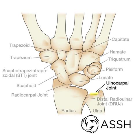 Ulnar-Sided Wrist Pain - Richard Stephen Gilbert, M.D.