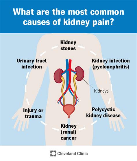 Kidney Pain: Causes, Treatment & When To Call A Doctor