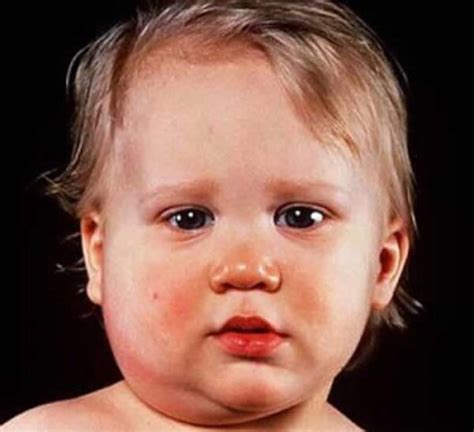 Mumps - Symptoms, What Mumps Look Like, Vaccine & Treatment