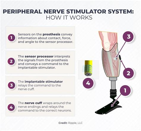 Next-gen Device Could Relieve Phantom Limb Pain | NIH HEAL Initiative