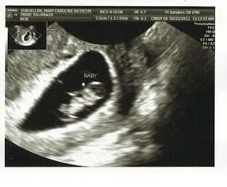 Peanut in the Pod: Ultrasound- 8 weeks, 2 days