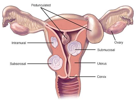 Uterine Fibroids - Causes, Symptoms, Diagnosis, Treatment & Pregnancy