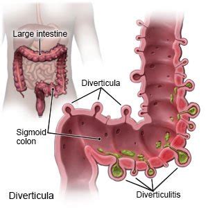 What Foods Can Aggravate Diverticulitis | Deporecipe.co