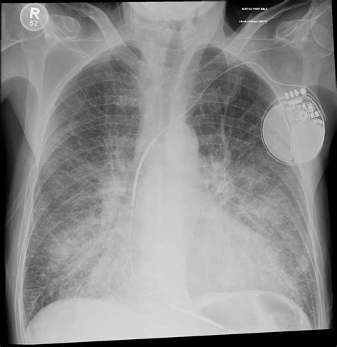 Pulmonary Edema Chest X Ray