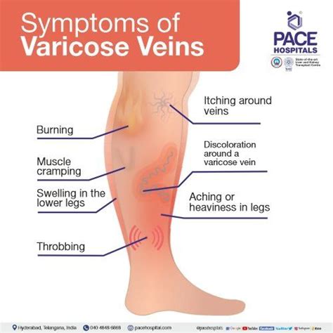 Varicose Veins Symptoms Causes And Natural Support Strategies | Hot Sex ...