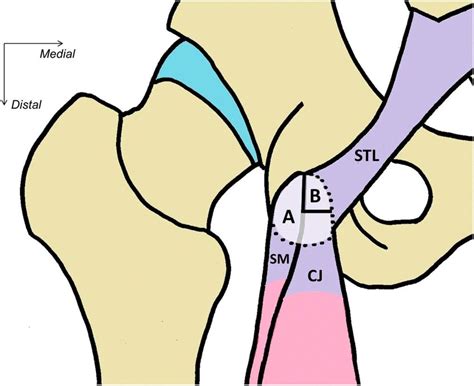 Hamstring Attachment Mri