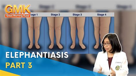 Elephantiasis: Symptoms, Causes, and Treatment (Part 3) | Usapang ...