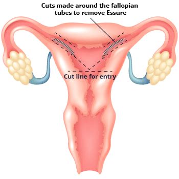 Essure Ultrasound