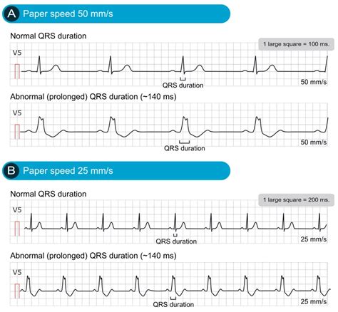 QRS Interval On Your Watch ECG Narrow, Normal, And Wide, 57% OFF