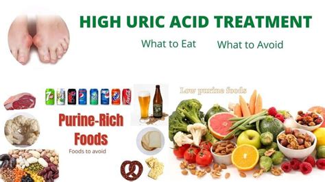 How to Treat Uric Acid Naturally : Diet and Recipes -NaturalCure ...