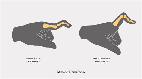 Swan neck deformity: Causes and treatment