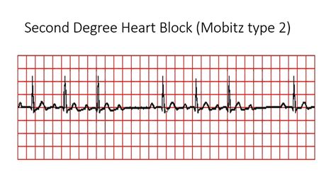 Study Medical Photos: ECG Findings In Different Types Of Heart Block.