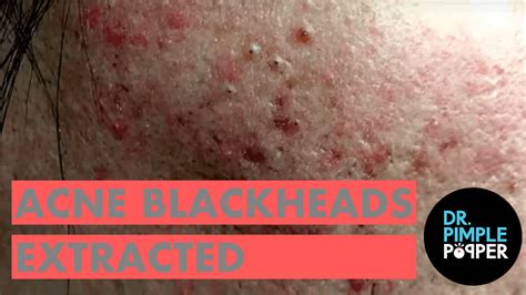 Acne blackheads extracted, Dr Sandra Lee - Blackheads & Whiteheads ...