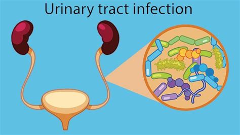 Demystifying E. coli Infections: Causes, Symptoms, Prevention, and ...