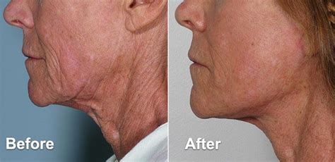 Mini Facelift vs. Full Facelift | Contour Dermatology