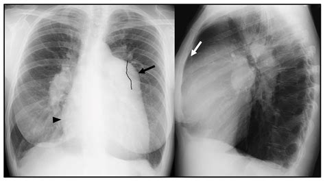 Interstitial Lung Disease X Ray