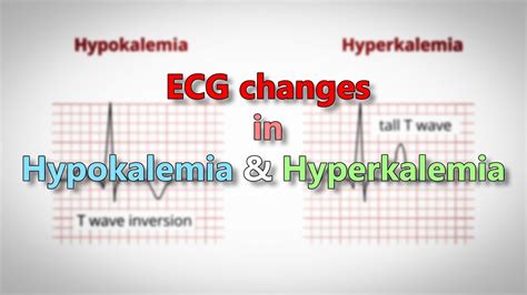 Ecg Changes Hypokalemia Vs Hyperkalemia Youtube | The Best Porn Website