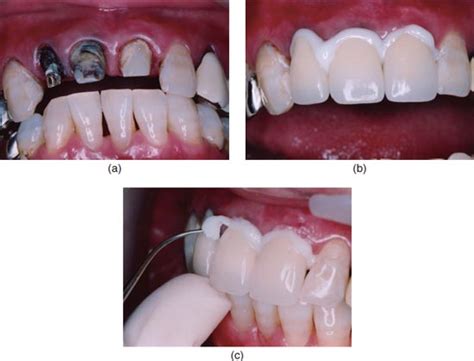 Dental Cement For Broken Tooth