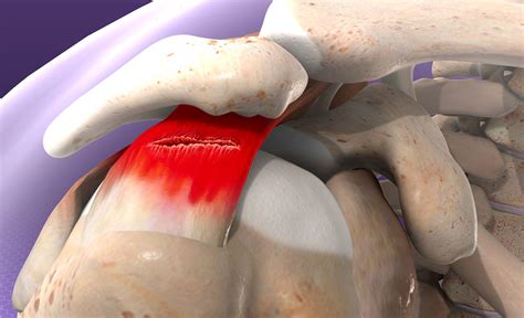 Supraspinatus Tear - Signs, Symptoms and Diagnosis