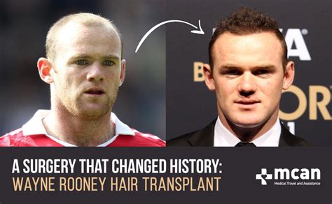 Wayne Rooney Hair Transplant Before and After