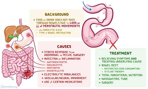 Adynamic Ileus: What Is It, Symptoms, Treatment | Osmosis