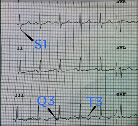 ECG Interpretation