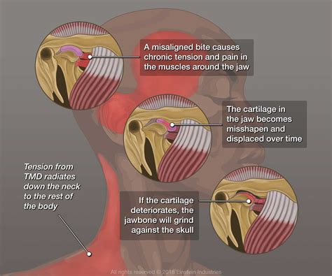 TMJ Missouri City, TX - Richmond, TX - Fort Bend County - TMJ Treatment ...