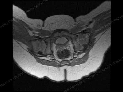 Developmental Hip Dysplasia in Babies and Young Children