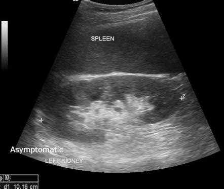 Perinephric abscess | Radiology Case | Radiopaedia.org