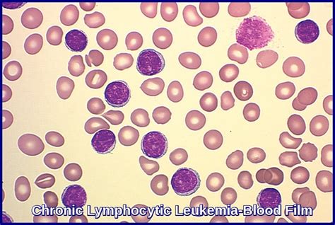 Chronic Lymphocytic Leukemia | Ask Hematologist | Understand Hematology