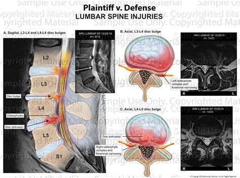 Disc Bulges / Stenosis L3-4 & L4-5 - MotionLit