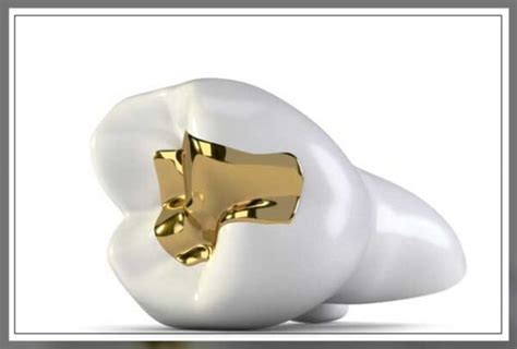 Gold Fillings: Pros and Cons - Engiomed