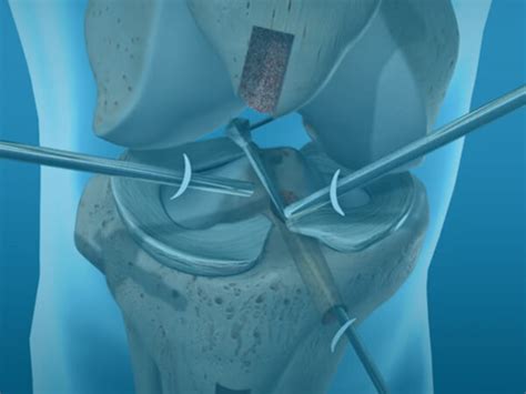 ACL Reconstruction Surgery at the Top Ranked Orthopaedic Hospital in ...