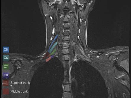 Brachial Plexus Injury Mri