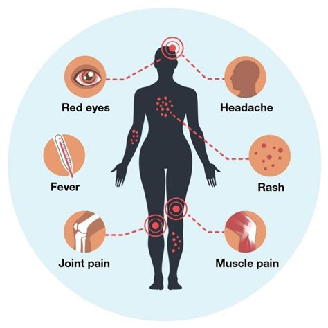 Zika Virus Disease: What Are The Causes, Symptoms and Treatment of This ...