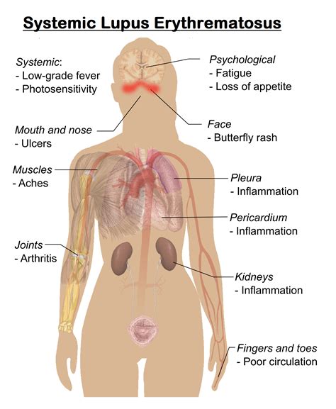 Systemic Lupus Erythematosus (SLE) - MedicoInfo