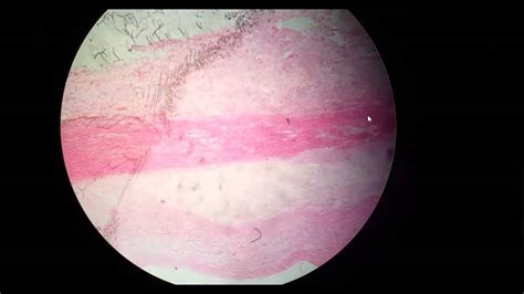 Atheroma histopathology - YouTube