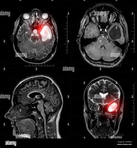 Brain stem swelling hi-res stock photography and images - Alamy