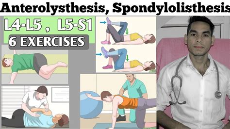 Anterolisthesis spondylolisthesis l4 L5-s1 exercise treatment, Low back ...