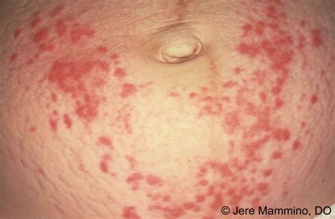 Pruritic Urticarial Papules and Plaques of Pregnancy - American ...