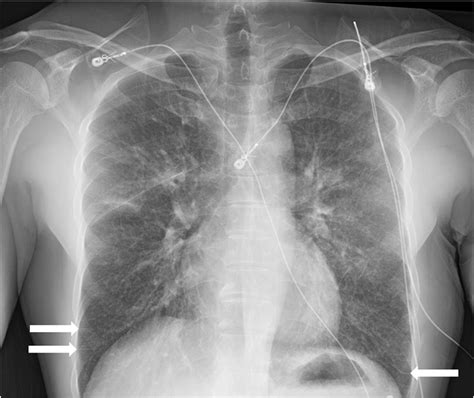 Chest x-ray showing interstitial lung edema with Kerley B Lines ...