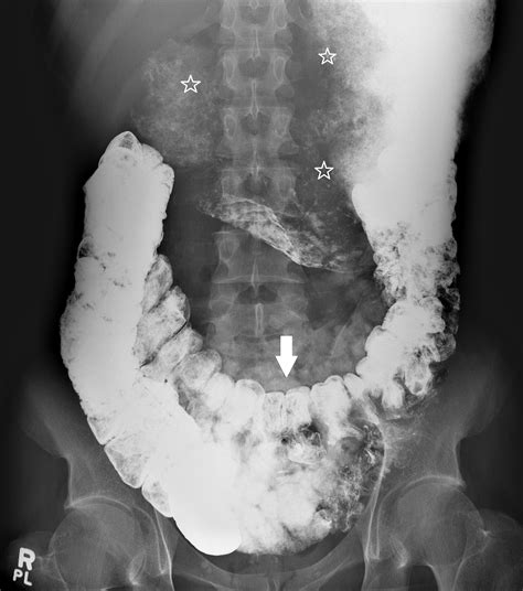 Cureus | Visceroptosis and the Ehlers-Danlos Syndrome