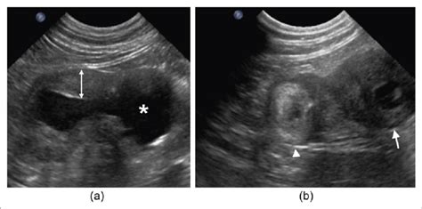 (a) Malignantly transformed duodenal duplication cyst in a longitudinal ...