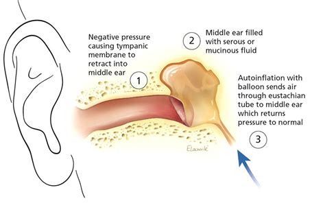 Simple nasal balloon procedure helps treat 'glue ear' in children ...