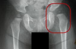 Infant Diagnosis - International Hip Dysplasia Institute